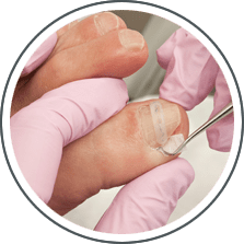 Ingrown Toenails