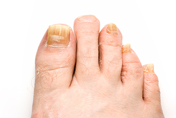 fungus toenails treatment in the Bellaire, TX 77401 area